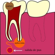 fistula_dental copy